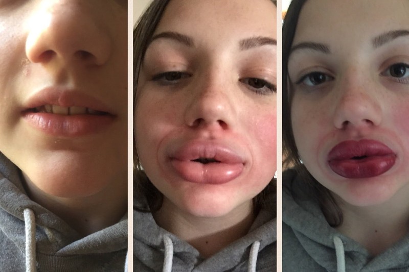 The Kylie Jenner challenge is leaving kids with swollen, bruised lips
